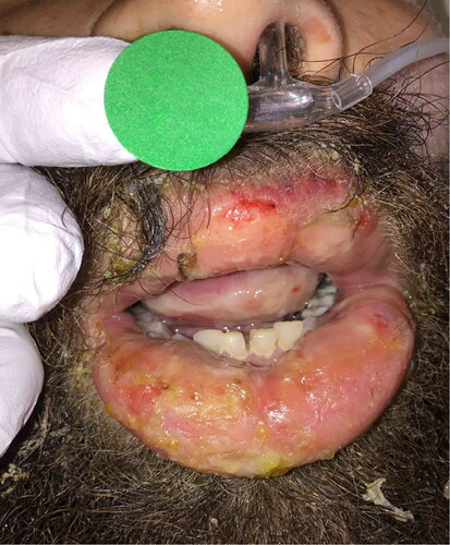 Figure 1. Angioedema of lips.
