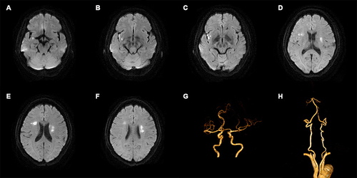 Figure 3 Typical neuroimage of a patient with acute ischemic stroke and active pulmonary tuberculosis. Images are from a male in his 50s who had acute ischemic stroke without conventional stroke risk factors and who was initially diagnosed with active pulmonary tuberculosis during the treatment of ischemic stroke. Six MRI diffusion-weighted images (picture A–F) show multiple high-signal lesions in multiple arterial regions of the brain. Two pictures of computed tomography angiography (picture G and H) show normal cerebral vessels.