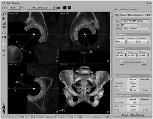 Figure 1. A cup planning model on the workstation. Cup angles and spatial position can be planned on a 3D pelvic model. Cup size was determined by referring to the anteroposterior width of the acetabulum, and inclination and anteversion were adjusted according to the stem anteversion angle needed to acquire the best range of motion. Finally, leg length was adjusted by changing the stem size and neck offset length.