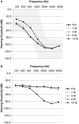 Figure 2. (A) Average audiogram of group 1. The lines indicate preoperative, 1, 3, 6, and 12 months postoperative audiograms. Note that good hearing preservation could be achieved. (B) Hearing level of group 1 with electric acoustic stimulation (EAS).