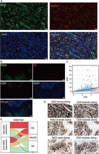 Figure 9 NID2 is related to the tumor immune microenvironment. (A) Double immunofluorescence staining images of NID2 and ACTA2 in the SKCM tissue. The representative view of the co-staining of NID2 and ACTA2 is shown in the enlarged image view below. Nuclei (DAPI) in blue (Magnification, ×400, scale bars = 20 μm). (B) Correlation between NID2 mRNA expression level and TIDE score was analyzed based on TCGA-SKCM (Spearman method, n = 471). (C) Representative co-stained images of NID2, CK, and CD8. According to the spatial distribution of CD8+ T cells. Measures were taken from different samples (Magnification, ×50, scale bars = 200 μm). (D) NID2/CD8 immunohistochemistry was performed on consecutive sections. Tumors were sliced as serial 3-μm sections and histologic sections were scored in a blinded manner by 2 pathologists (Magnification, ×400, scale bars = 50 μm). (E) The Sankey diagram fully demonstrated the difference in response to immunotherapy between high and low NID2 expression groups based on GSE91061.