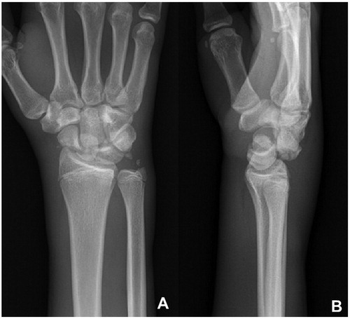 Figure 1. (A and B) Pre-operative x-rays of the first case.