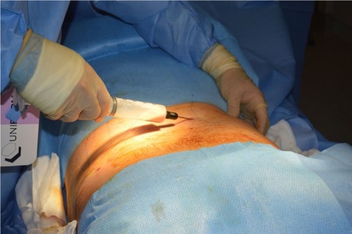Figure 1 Small volume liposuction.
