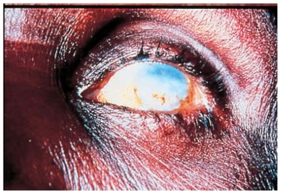 Figure 3 Sclerosing Keratitis in an African subject infested with Onchocerca volvulus.