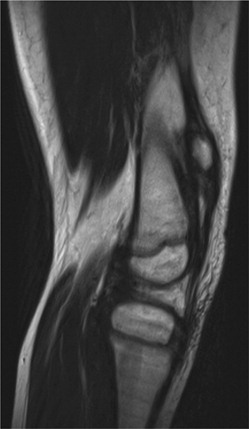 Figure 2. T2 weighted MRI image of the left knee. The patella is proximally located. The ligamentum patella is seen with normal thickness and signal intensity in the most proximal part, but is ruptured distally.