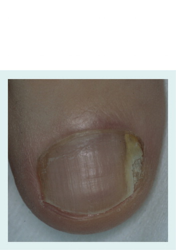 Figure 2. Distal subungual onychomycosis caused by Trichophyton rubrum in a 7-year-old boy: lateral onycholysis and mild subungual hyperkeratosis can be seen.