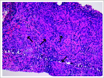 Figure 2. Development of splenic sarcoidosis-like lesions in melanoma patient with durable response to ipilimumab. Ultrasound guided biopsy and histological examination of the hypodense lesions in the spleen of ipilimumab treated melanoma patient showing several non-caseating epithelioid cell granulomas (black arrows) consistent with sarcoidosis (hematoxylin-eosin stain; original magnification × 20, scale bar 500 μm).