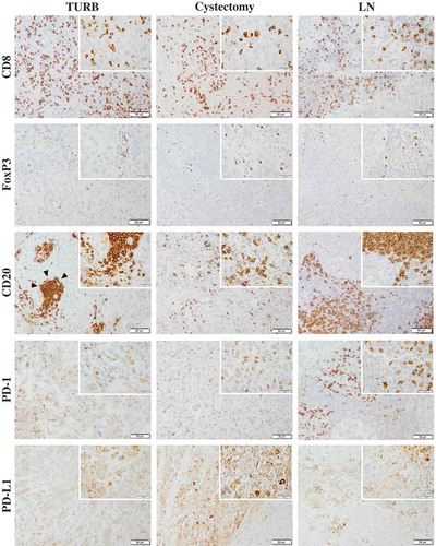 Figure 1. Immunohistochemical staining of CD8, FoxP3, CD20, PD-1 and PD-L1 in muscle invasive bladder cancer. Sample images (10x magnification with 40x insertion) of studied cell subsets in TURB specimens, cystectomy specimens and lymph node metastases (LN). The estimated percentage of stained cells was annotated. Arrow-heads illustrating a lymphoid aggregate of CD20+ B cells. Scale bar = 50 μm (10x) and 20 μm (40x).