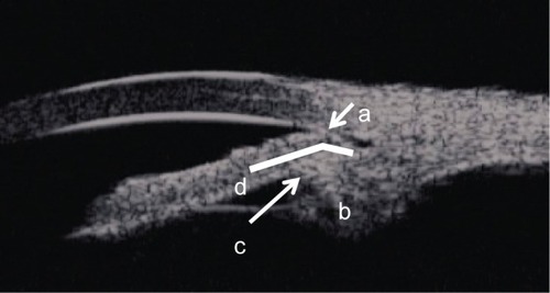 Figure 1 Ultrasound biomicroscopy image of a quadrant of a primary angle closure glaucoma eye with plateau iris.