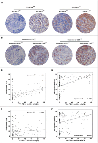 Figure 1. Evaluation of CD3, PD-L1 protein and their associations in nasopharyngeal carcinoma patients. Tumor and immune cell PD-L1 protein (A) and intratumoral and peritumoral CD3+ lymphocytes (B). Correlation between intratumoral (C) or peritumoral CD3+ lymphocytes and TCs-PD-L1 (D), and correlation between intratumoral (E) or peritumoral CD3+ lymphocytes (F) and ICs- PD-L1 expression.