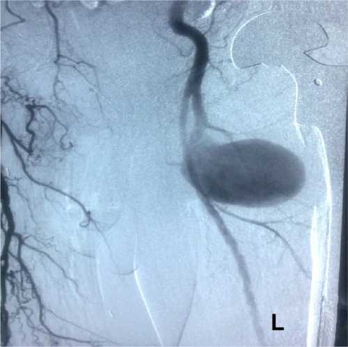 Figure 2 Angiogram showing the pseudoaneurysm was detected in profunda branch of femoris artery and periprosthetic destructive area.