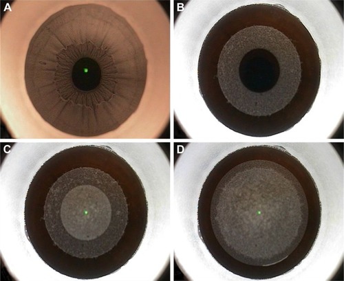 Figure 1 Femtosecond laser application in small incision lenticule extraction.