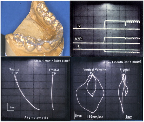 Figure 5. Fabricated CMO appliance on the mandible cast model had anatomical occlusal morphology (top-left). Jaw movements were recorded using MKG K5 after use of the CMO appliance for 1 month. Jaw open–close movements were smooth (bottom-left), and velocity of the movements was significantly improved (bottom-right). However, ICP appeared not yet stable (bottom-right). The recording of three-dimensional jaw movement from rest position shows that the mandible travels approximately 1·5 mm vertically, 1 mm anteriorly, and 0·2 mm laterally at the incisal position.
