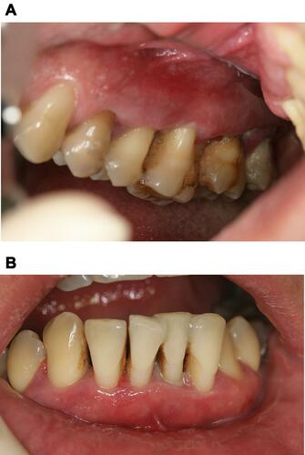 Figure 1 (A) Intraoral view of the upper right quadrant at baseline; calculus and gum bleeding is visible. (B) Intraoral view of the frontal lower teeth at baseline; small amounts of calculus and pus discharge are visible.