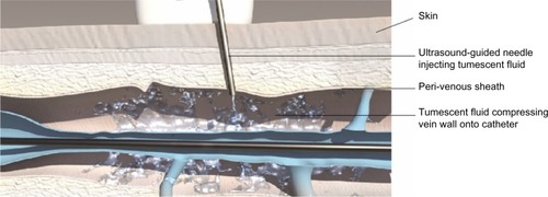 Figure 2 Diagram showing the injection of tumescent fluid, using ultrasound control, into the perivenous sheath in order to compress the vein wall onto the Closure Fast™ catheter (ClosureFAST, Covidien, Dublin, Ireland).