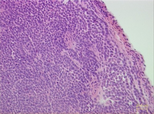 Figure 1 Pathological section of tumor formed 3 weeks after the inoculation of Tca8113 cells into the cheek of nude mice (hematoxylin and eosin stain, ×200).