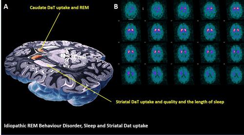 Figure 1 Schematic presentation (A) of links between sleep in iRBD and caudate and putamen DaT uptakes. Serial SPECT images from representative iRBD patient (B) show labelling of the basal ganglia with 123I-FP-CIT.