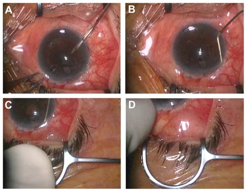 Figure 2 The procedures of the blunt needle revision technique via the anterior chamber to treat failed filtering blebs. A paracentesis is created by perforating the anterior chamber from the inferior corneal limbus (A). A 27-gauge blunt needle attached to a syringe containing viscoelastic materials is inserted into the anterior chamber. The blunt needle tip is then inserted into the subscleral flap space from the filtering fistula, and the scleral flap is lifted bluntly (B). The needle tip is then inserted into the subconjunctival space where the viscoelastic material is injected, and the adhesion between the sclera and conjunctiva separated bluntly (C). The eyeball is pressed slightly to confirm adequate flow from the anterior chamber into the filtering bleb (D).