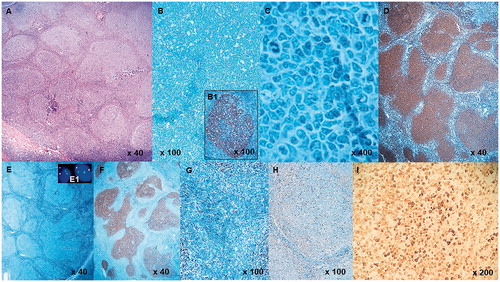 Figure 1. nodal architecture is totally effaced by large expansile follicles (A Hematoxylin/Eosin staining); confluent follicles show a starry sky pattern (B Giemsa staining) along to large centrocytes, centroblasts and blastoid cells (C Giemsa staining). Neoplastic follicles lose polarisation as revealed by immunostaining for Ki67 (insert B1) and express CD20 (D), CD10 (F), BCL6 (G) with very few scattered BCL6+ cells in the interfollicular region. Neoplastic germinal centres show a diffuse and strong nuclear staining for FOXP1 (I) whereas BCL2 (E) and IRF4/MUM1 (H) were absent. FISH analysis demonstrated the absence of BCL2/IGH rearrangement (insert E1).