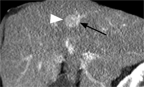 Figure 4 Man, 57 years old, with HCV cirrhosis. Sagittal CT image during the portal venous phase shows a portal vein (black arrow) along the posterior aspect of a pathologically confirmed HCC (white arrow). No other vessels were noted to be abutting tumour. Modified heat capacity was found to be 262.22 J/°C, well below the study population mean of 366.34 J/°C.