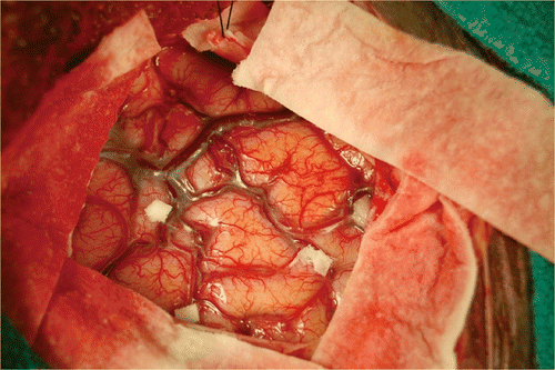 Figure 5. Clinical evaluation: paper tags on the cortical surface.