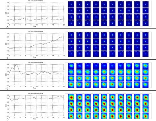 Figure 1 Dynamic changes of objective scatter index (OSI) of an illustrative case in the control (A) and dry eye disease groups (B–D). A) Steady-low value of OSI; (B) ladder pattern displayed ascending values of OSI; (C) seesaw pattern revealed repeatedly fluctuation of OSI; (D) plateau pattern showed a steady-high value of OSI.