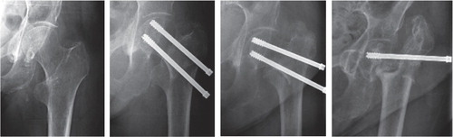 Figure 1. A. Undislocated primary fracture. B. The day after surgery, showing dislocation. C. Two months postoperatively. D. Six years postoperatively.
