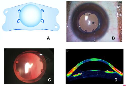 Figure 1 (A) Computer graphic of Refractive intraocular lens. (B) Intra-operative View of RIL under surgical microscope. (C) Retro-illumination view with slit lamp Biomicroscope. (D) Vault Height assessment with anterior segment OCT (Zeiss Inc., Jena, Germany).