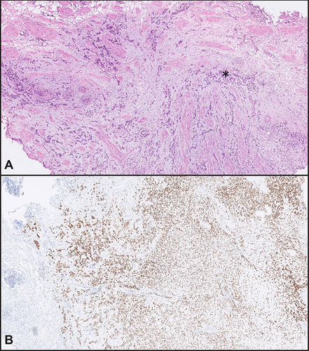 Figure 2 Poorly differentiated tumor with invasion of muscularis propria is present in TURBT specimen (asterisk). (A) Extensive cautery artifacts made histologic evaluation difficult (HE stain). (B) Strong positive nuclear reaction to GATA3 in bladder tumor, falsely indicating the tumor to be of urothelial origin.