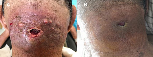 Figure 1 Patient 1: (A) lesion after debridement. (B) lesion after 20 days of fire needle treatment.