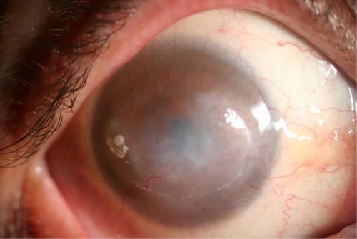 Figure 1 Corneal Haze in a Patient with Anesthetic Keratopathy.