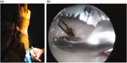 Figure 2. (a) The placement of the Micro SutureLasso Straight through the ulnar tunnel and the grasper through the 6 R arthroscopic portal. (b) The grasper is pulling the wire-loop from the SutureLasso.