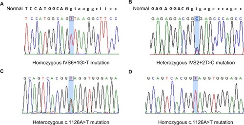 Figure 1 Direct DNA sequencing of the F7 gene in our study revealed homozygous C.681+1G>T (IVS6+1G>T) mutation in Patients 1 and 4 (A), compound heterozygous c.291+2T>C (IVS2+2T>C) (B), and c.1126A>T (p.K376X) (C) mutations in Patient 2, and homozygous c.1126A>T (p.K376X) (D) mutation in Patient 3.