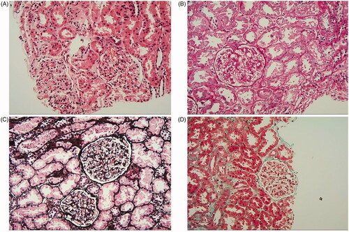 Figure 2. Histological examination of a renal biopsy showed minimal change disease (MCD) and there was no typical infiltration of eosinophil in the renal tissue. (A) The lesion shows mild in the glomerulus(H&E staining × 200). (B) Mesangial cells proliferation and mesangial matrix expansion (PAS staining × 200). (C) No thickening in glomerulus basement membrane and the glomerular capillary loops open well (PASM staining × 200). (D) There is no obvious immune complex deposition in the glomerulus (Mason staining × 200).