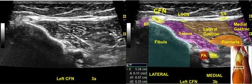 Figure 3 A normal left common fibular nerve (CFN) with a cross-sectional area (CSA) at the upper limits of normal (11 mm2) at fibular head (A and B).Citation24,Citation25 3a is the original ultrasound image, (B) Shows the highlighted CSA of the normal left CFN and the color shadings with labels for sonoanatomy, Image is courtesy of 3D4Medical’s Essential Anatomy 5 app.Abbreviations: BF, biceps femoris; Gastroc, gastrocnemius; LSCN, lateral sural cutaneous nerve; PA, popliteal artery; SN, sural nerve; TN, tibial nerve.