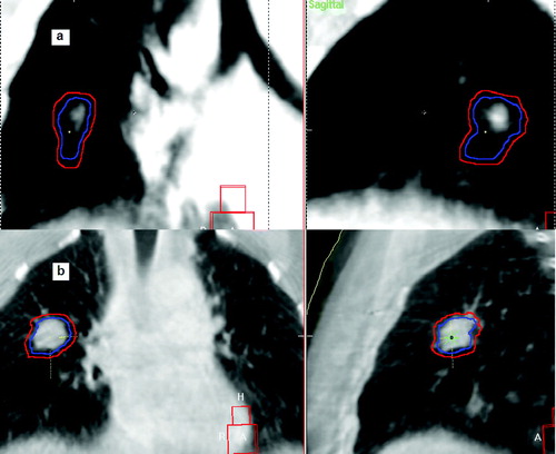 Figure 5.  Qualitative comparison between the ITV contour (in blue) and the dimensions of the visible tumor on CBCT (the PTV contour, in red, is also shown): a) example for a patient of group A. b) example for a patient of group B.