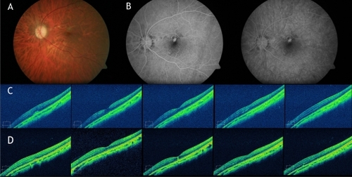 Figure 2 Fundus examination. A) Retinography showing disciform-like scar RE and juxtafoveal fibrovascular proliferation LE. B) Angiogram showing predominantly classic choroidal neovascular membrane (CNV). C) Spectral-domain optical coherence tomography (SD-OCT) images showing the subretinal choroidal neovascular membrane inducing loss of foveal anatomy. D) SD-OCT images showing complete resolution of the retinal edema and normalization of the foveal anatomy after three monthly intravitreal ranibizumab injections.