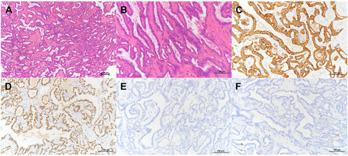 Figure 4 The tumor displayed papillary structures with a hyalinized fibrovascular cores and a prominent intervening spindle cell component ((A), H&E staining, x100). The papillae were lined by bland columnar epithelium with elongated slightly crowded nuclei which displayed fine chromatin and absent to inconspicuous nucleoli ((B), H&E staining, x200). Immunophenotype for TL-LGNPPA showed both tumor cells were strongly positive for CK7 and TTF ((C and D), immunohistochemical [IHC], x200), and negative for TG ((E), immunohistochemical [IHC], x200). The Ki-67 proliferation value was about 1% ((F), immunohistochemical [IHC], x200).