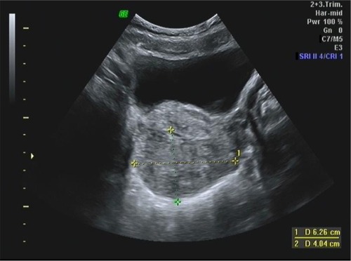 Figure 7 Transabdominal ultrasound scan in an 8-year-old girl with abdominal pain.