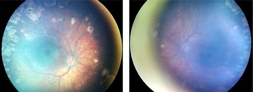 Figure 2 A female infant who was born at 31 weeks’ gestation and of birth weight 1.600 g. OU: ROP stage 2, zone 1, with plus disease. ROP regressed bilaterally after laser treatment. Refraction at 62 months of age: OD, −3.00 D/−1.75 D, axis 0 degrees; OS, −2.50/−2.00, axis 180 degrees.