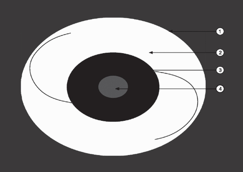 Figure 2 Schematic illustration of the IOL (optic with the haptics) in the capsular bag (arrow 1 = lens equator). Note the area around the optic (arrow 2, white area), where Sommering’s ring was evaluated, the peripheral area of the optic (arrow 3, dark grey), where peripheral PCO was evaluated and the central area of the optic (arrow 4, light grey area), where central PCO was evaluated.