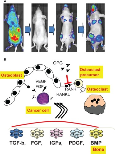 Figure 1 Bone as an ideal site for metastatic cancer cells. After injection into the left ventricle, luciferase-labeled cancer cells initially appeared as diffuse photon accumulations throughout the body, were completely undetectable after 6 hours, and subsequently developed bone metastases (A). Schematic representation of the interplay between metastatic cancer cells, osteoblasts and osteoclasts in bone, and of the function of the RANK/RANKL/OPG axis. various growth factors are released when osteoclasts absorb bone that provides fertile ground for cancer cells to grow. Cancer cells activate osteoblasts to increase the production of RANKL. RANKL then interacts with RANK and promotes differentiation into mature osteoclasts. OPG acts as an inhibitor of osteoclastogenesis by serving as a decoy receptor for RANKL (B). RANK: receptor activator of nuclear factor κB.