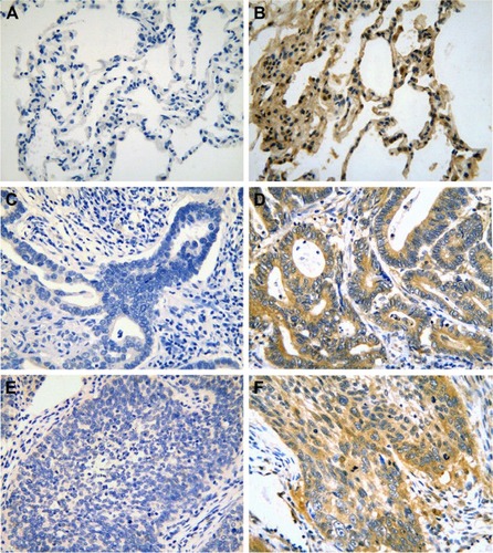 Figure 1 Immunohistochemical staining of DcR3 expression in lung cancers.