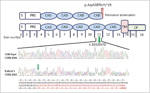 Figure 3. Schematic representation of the CDH1 gene mutation and parallel sequencing of exon 11 of the CDH1 gene. The mutation located in the central region of the CDH1gene encodes for the fourth protein extracellular domain containing a calcium binding site. The c.1612G deletion (green arrow) in the exon 11 causes a frameshift of amino acids change resulting in a premature stop codon (p.Asp538Thrfs*19; red arrow). Structurally, the E-cadherin comprises a number of domains: a signal sequence (S); a propeptide of around 130 residues (PRE); 5 tandemly repeated extracellular cadherin domains (ECAD); a single transmembrane domain (TM) and a N-terminal cytoplasmic domain (CP). Analysed four-color sequencing electropherograms. Top: partial CDH1 exon 11 wild-type sequence; bottom: the parallel CDH1 exon 11 sequence from the patient's DNA. Red sequence shows the deletion resulting in the relative loss of wild-type CDH1 allele with a stop codon.