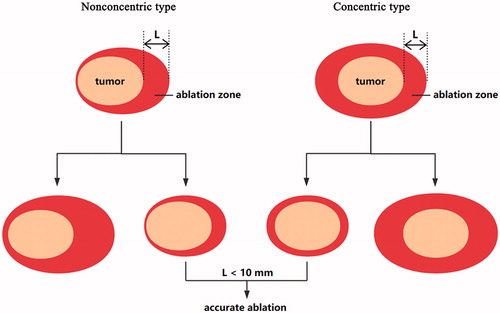 Figure 1. The illustration of two types of complete MWA: concentric type and nonconcentric type. The largest ablated margin (L) around the tumour was measured in US. When the largest margin was <10 mm, the case was defined as accurate ablation.