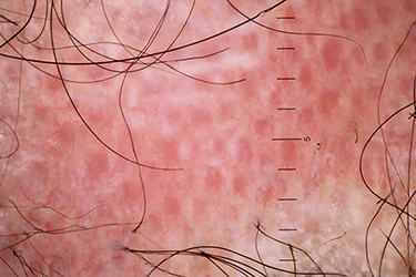 Figure 3 Trichoscopy of scalp discoid lupus erythematosus shows follicular red dots, interfollicular pink-white structureless area, and polymorphous vessels.