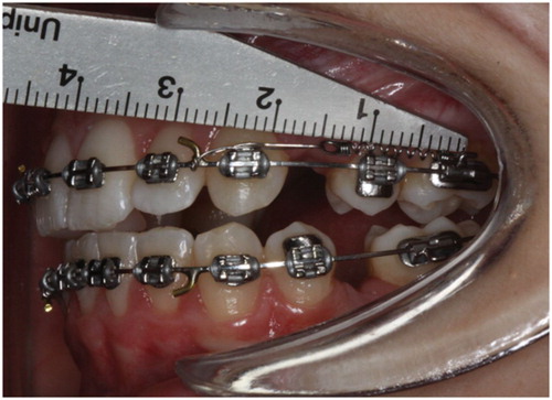 Figure 1. Standardized activation of nickel–titanium closing spring to approximately twice the resting length (12 mm)