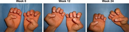Figure 2 Patient affected by nail psoriasis at baseline (week 0). The same patient after 12 weeks and 24 weeks of treatment with apremilast.
