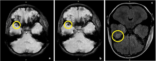 Figure 2 An 8-year-old pedestrian girl was involved in a motor vehicle accident. (a and b) Eighteen hours after admission, an MRI was performed. Hemorrhagic CC in the anterior part of the right temporal lobe appears as an area of hypointense SWI signal (yellow circle). (c) corresponding FLAIR signal imaging at the same level, showcasing hyperintense cortical (yellow circle).
