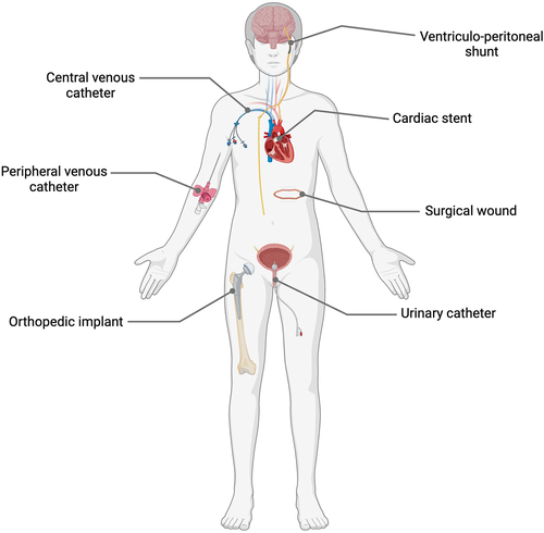 Figure 1. Medical interventions including surgical wounds and various implanted medical devices associated with increased risk of S. epidermidis and other CoNS opportunistic infections. Created with Biorender.com.